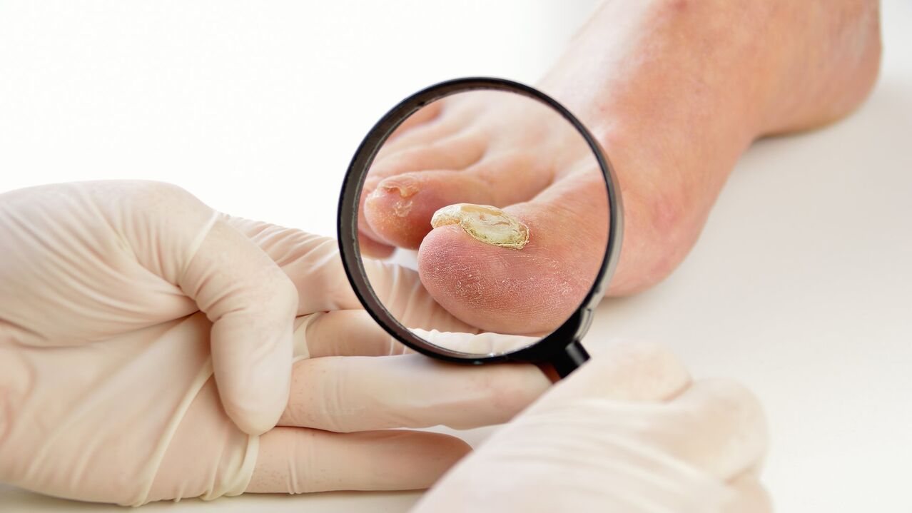 Tratamiento de hongos en las uñas con crema Keramin.