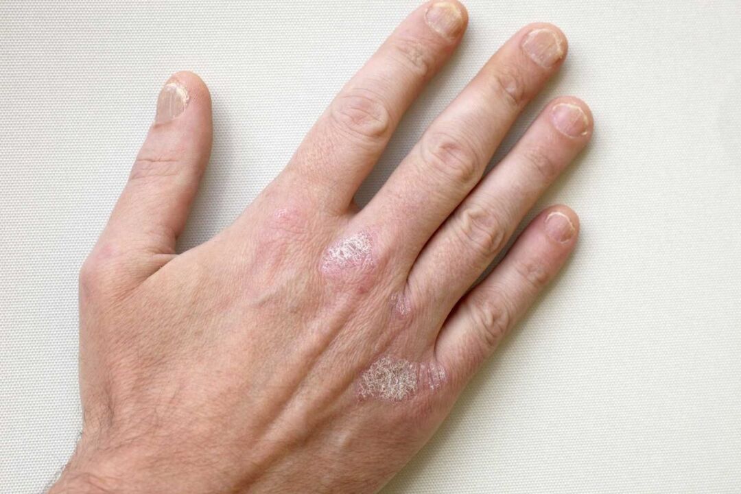 psoriasis en manos de un hombre tratado con crema Keramin