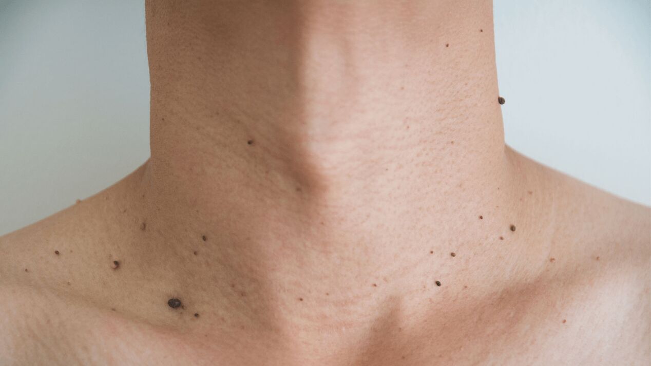 tratamiento con crema Keramin para papilomas de cuello y escote